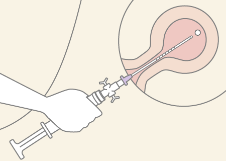 カニューレを子宮腔内にやさしく挿入