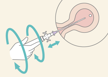 シリンジ部分を回転させたり、軽く前後させたりして子宮内容物を吸引最後にエコーで確認して終了